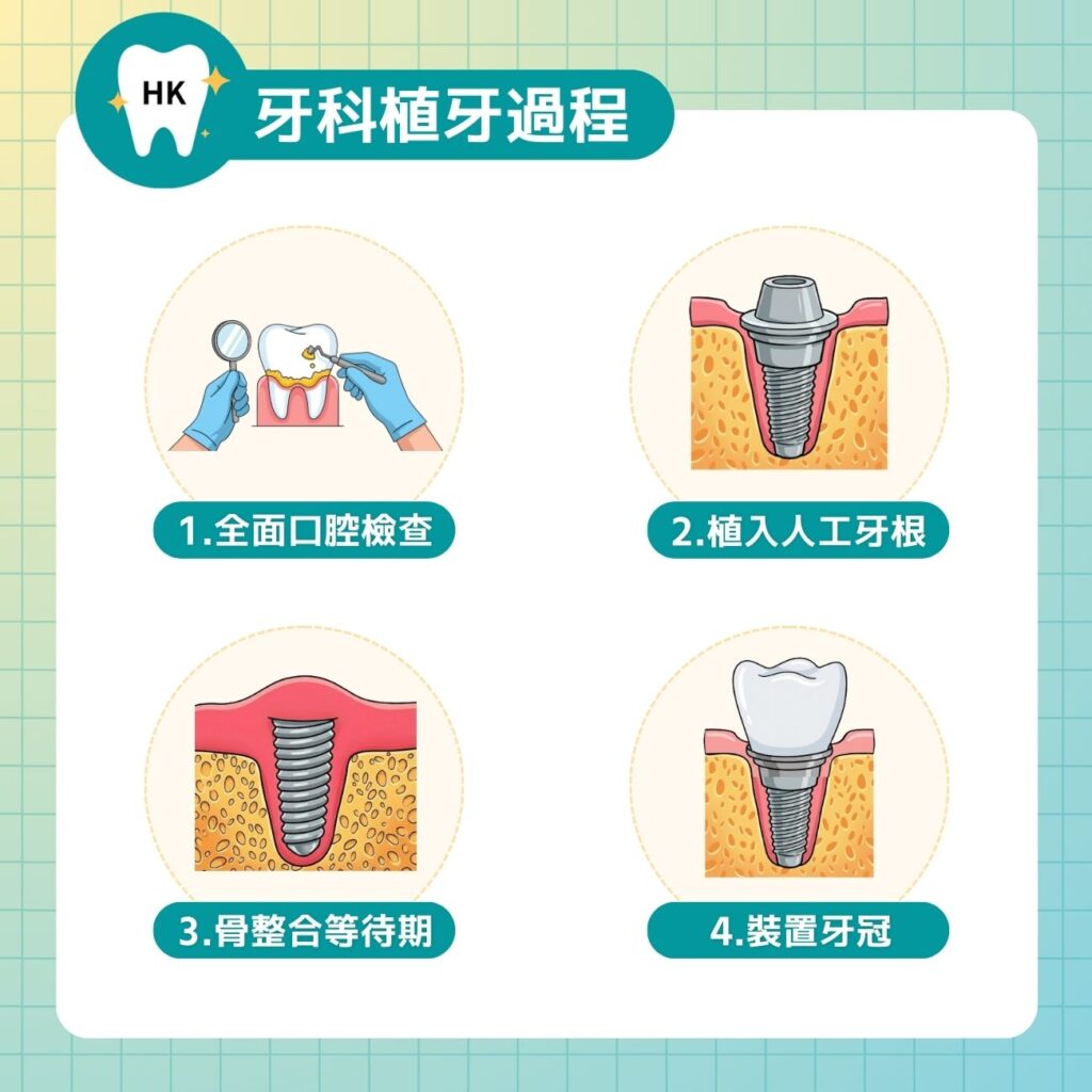 牙科植牙過程