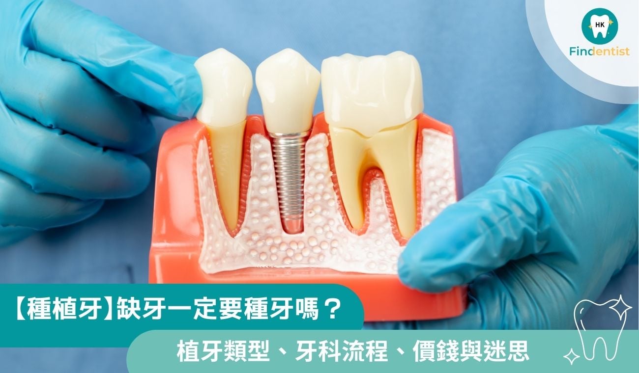 【種植牙】缺牙一定要 種牙嗎?3大植牙類型、牙科流程、價錢與迷思全指南