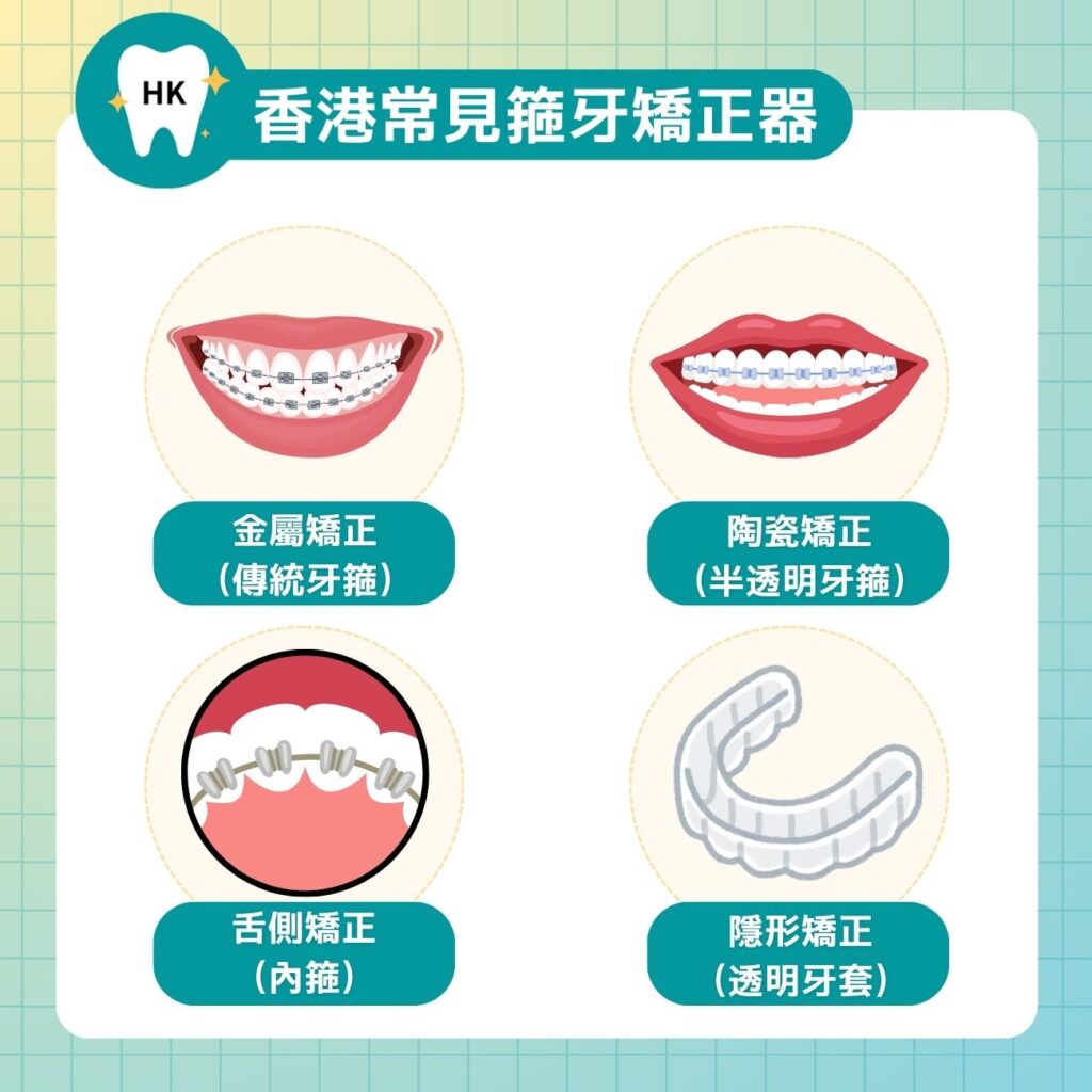 香港常見箍牙矯正器