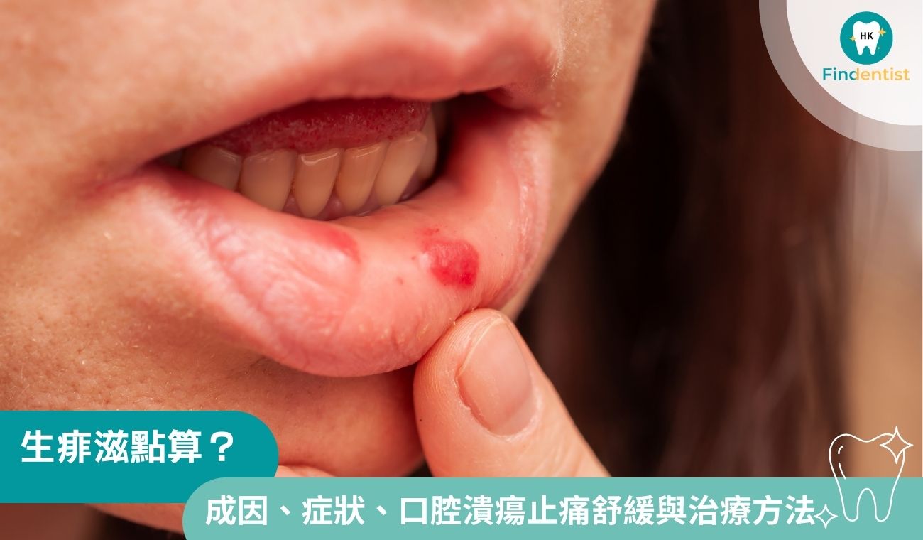 生痱滋點算？一文拆解痱滋成因、症狀與口腔潰瘍治療方法