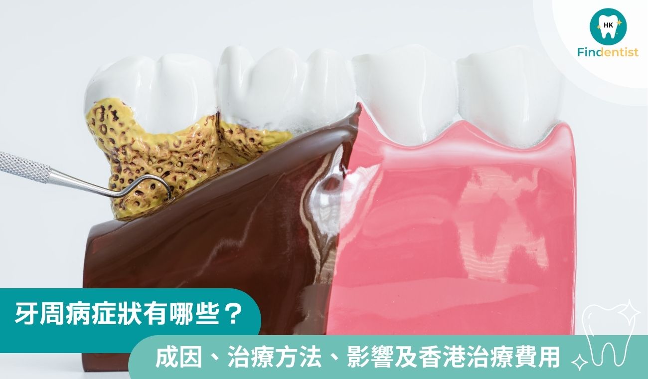 牙周病症狀有哪些？一文看清牙周病成因、治療方法、影響及香港治療費用