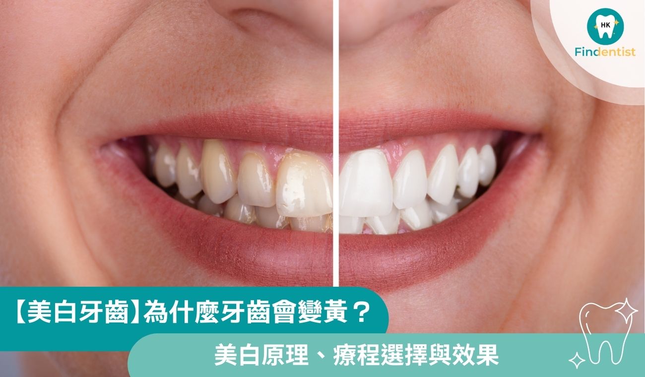 【美白牙齒】為什麼牙齒會變黃？美白原理、療程選擇與效果一文看清
