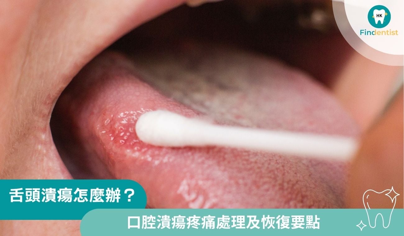 舌頭潰瘍怎麼辦？分享3種口腔潰瘍疼痛處理及恢復要點