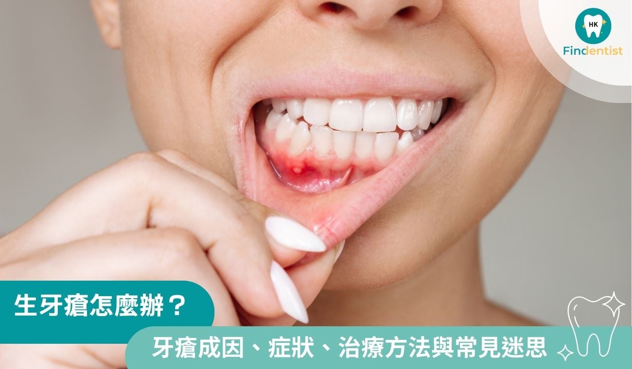 生牙瘡怎麼辦？一文看清牙瘡成因、症狀、治療方法與常見迷思