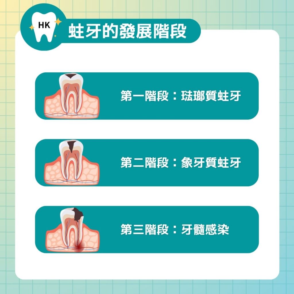 蛀牙的發展階段