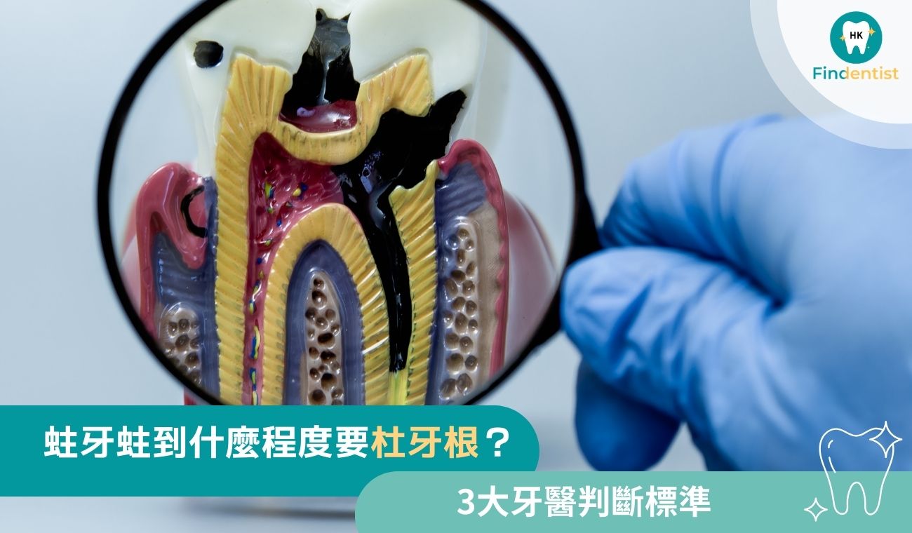 蛀牙蛀到什麼程度要杜牙根？牙醫判斷標準