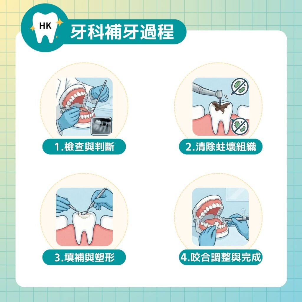 牙科補牙過程