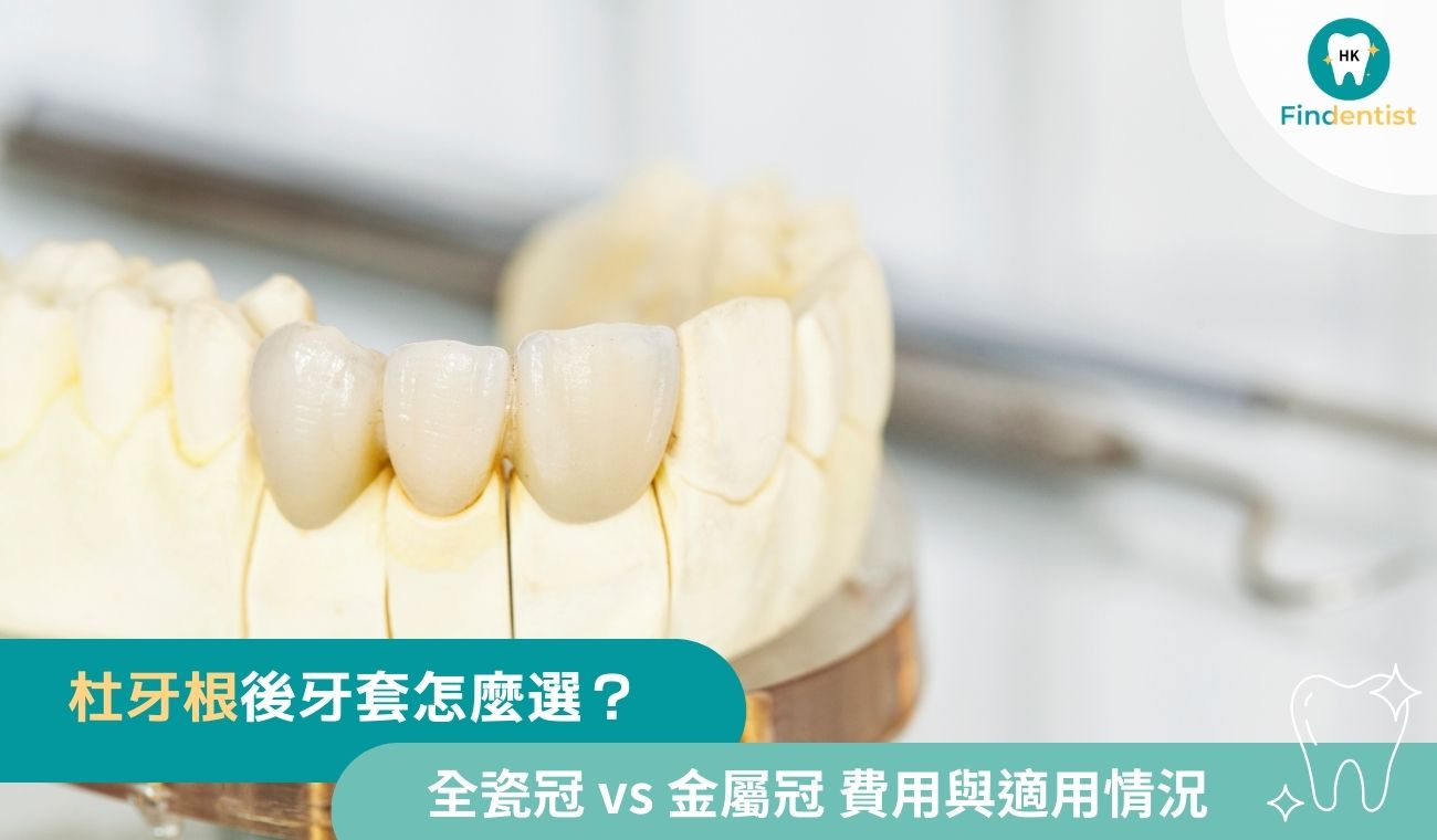 杜牙根後牙套怎麼選？全瓷冠 vs 金屬冠比較｜好牙醫