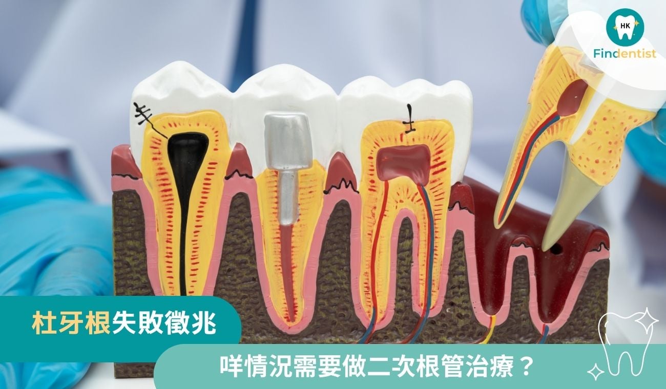 杜牙根失敗徵兆：幾時需要二次治療？｜好牙醫