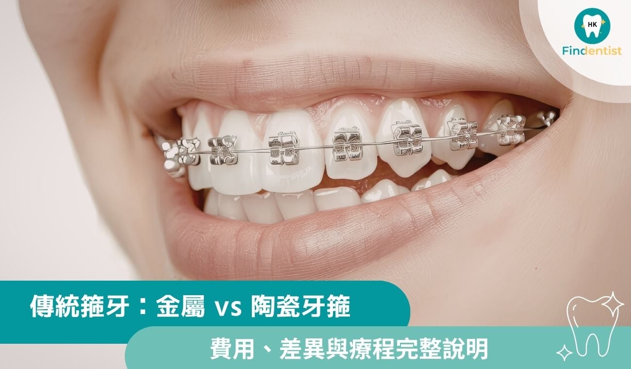 傳統箍牙好嗎？金屬vs陶瓷牙箍費用、差異與療程完整說明